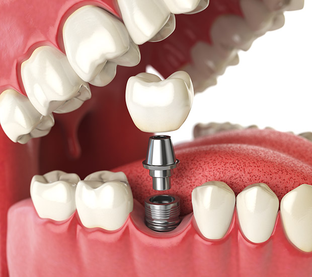 Lakewood Will I Need a Bone Graft for Dental Implants