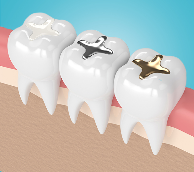 Lakewood Composite Fillings