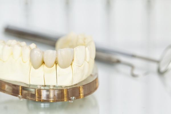 A Snapshot Of The Four Types Of Dental Bridges