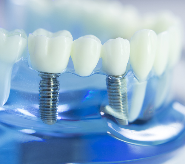 Lakewood Dental Implants