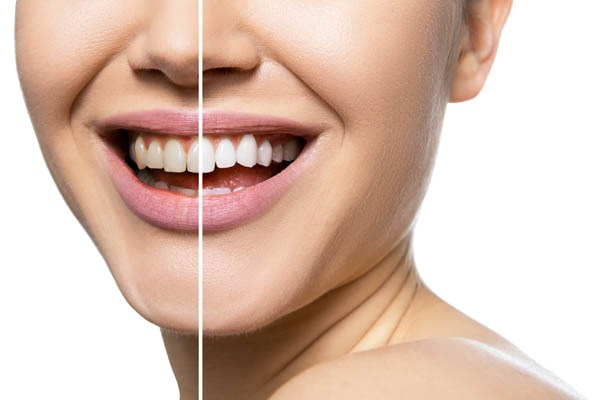 How Zoom Teeth Whitening Uses Light